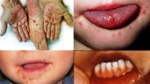 Waspada! Flu Singapura Mulai Serang Balita di Bolsel